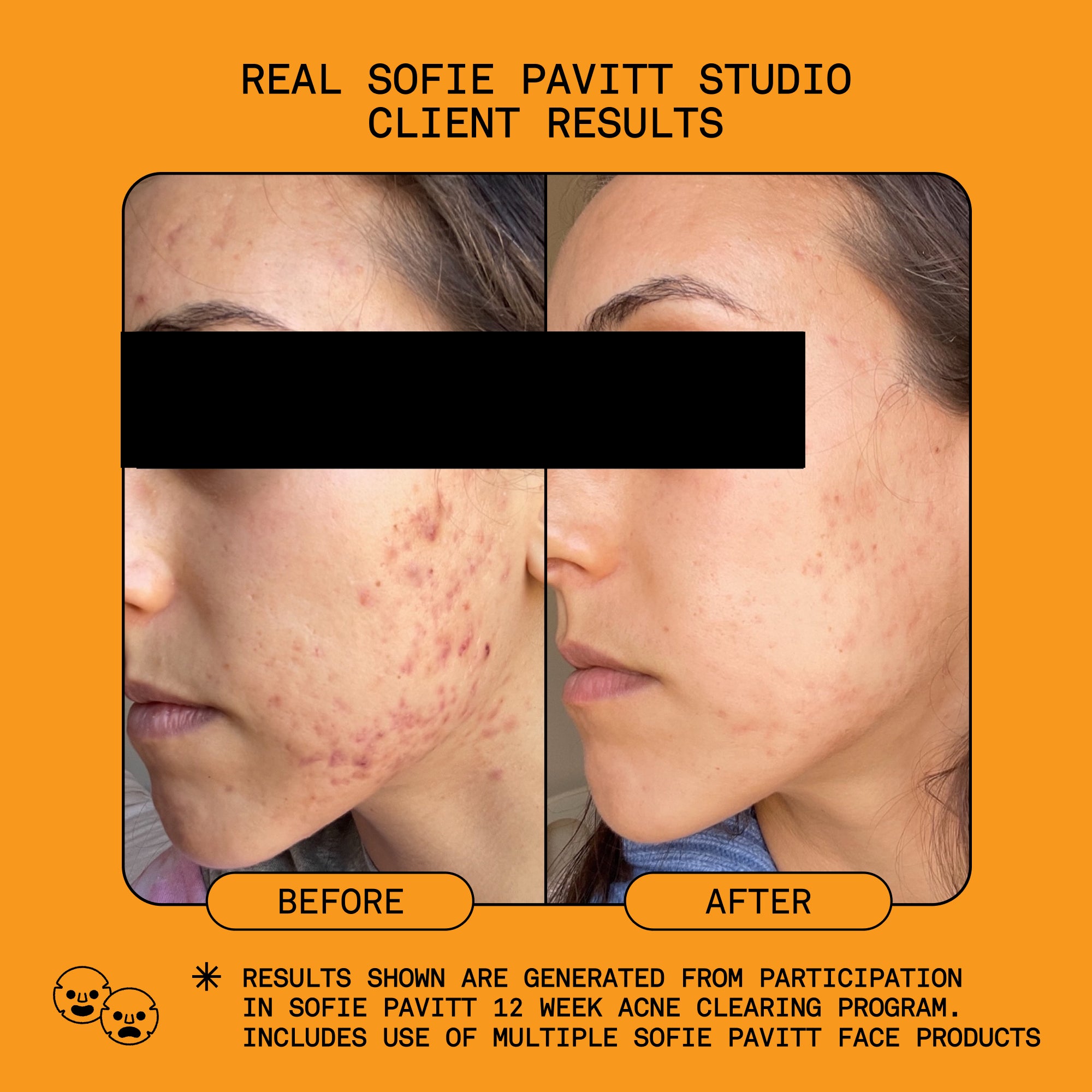 RESET Benzoyl Peroxide Acne Treatment, 1oz